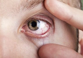 scleral lenses for dry eye